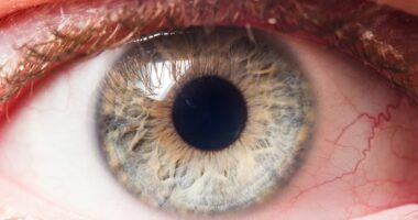 The silent blindness epidemic: Glaucoma cases soar as millions go undiagnosed