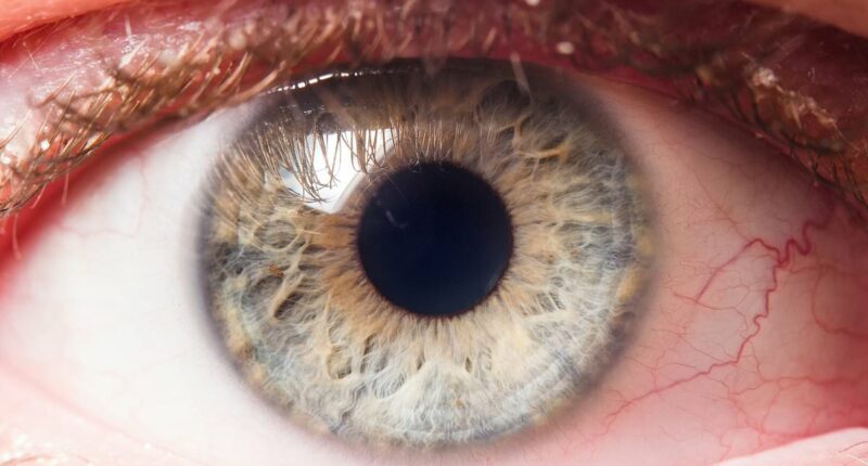 The silent blindness epidemic: Glaucoma cases soar as millions go undiagnosed