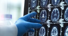 The size of your head can reveal your risk for devastating neurological disease