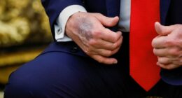 Trump blames hand bruises on high aspirin dose