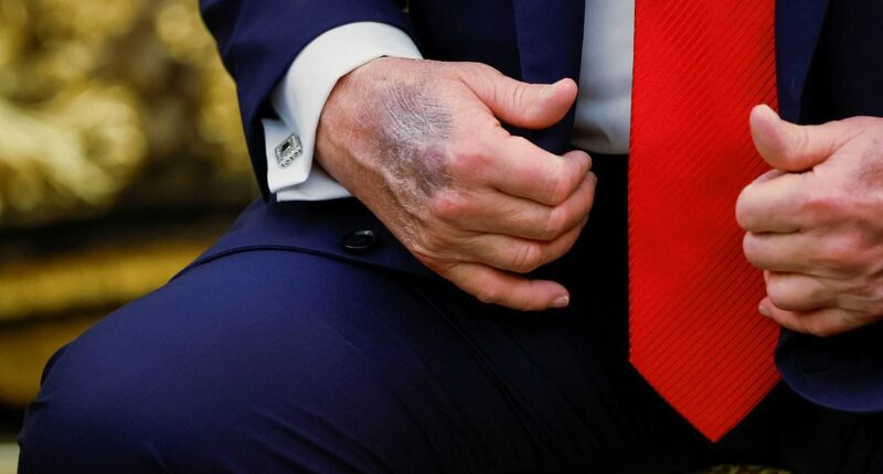 Trump blames hand bruises on high aspirin dose