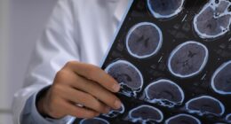 UK stroke victims could soar to over 400-a-day unless Labour step up prevention