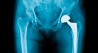 Almost a MILLION people will have knee and hip replacements cancelled... as interactive map reveals areas where waiting lists will soar