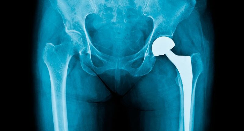 Almost a MILLION people will have knee and hip replacements cancelled... as interactive map reveals areas where waiting lists will soar