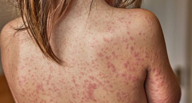 As fears London is about to be gripped by 'fast spreading measles outbreak', these are the warning signs... and it's not only a disease that infects children