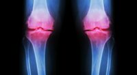 Experts reveal worrying cause behind the surge in younger people being diagnosed with bone injuries linked to osteoarthritis