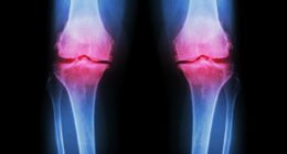 Experts reveal worrying cause behind the surge in younger people being diagnosed with bone injuries linked to osteoarthritis