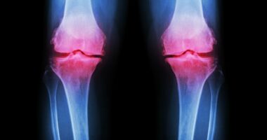 Experts reveal worrying cause behind the surge in younger people being diagnosed with bone injuries linked to osteoarthritis