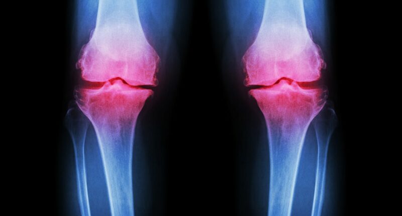 Experts reveal worrying cause behind the surge in younger people being diagnosed with bone injuries linked to osteoarthritis