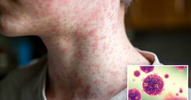 Fourth measles case confirmed in LA county, community urged to take precautions