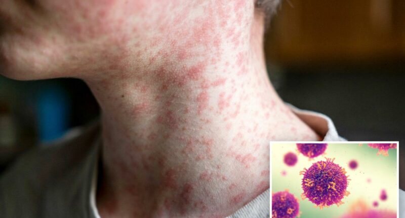 Fourth measles case confirmed in LA county, community urged to take precautions