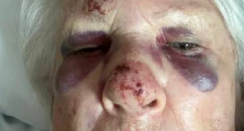 Grandmother reveals horrific injuries after being mowed down by e-bike
