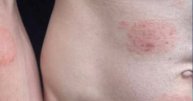 Largest known outbreak of highly contagious RINGWORM ripping through Minnesota