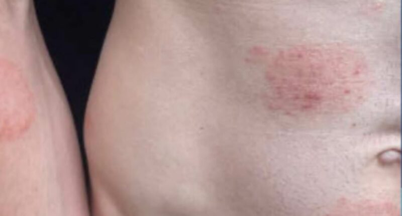 Largest known outbreak of highly contagious RINGWORM ripping through Minnesota