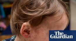 Measles: how does it spread and how can I protect my child?