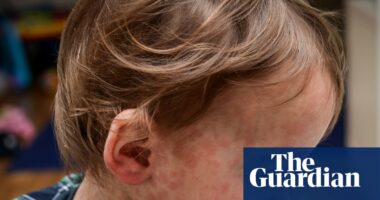 Measles: how does it spread and how can I protect my child?