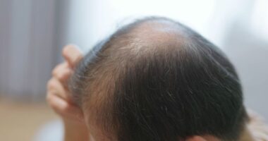 Millions of Britons balding too soon due to 1 common habit