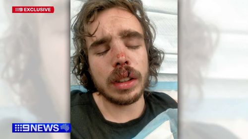 Aï»¿ Melbourne tradie has been left with serious injuries to his face after being attacked by an e-scooter rider in a road rage incident.Tyler Macaloney was driving home from his panel beating job in Parkville onï»¿ Friday when he was confronted by a man who was weaving in and out of traffic.