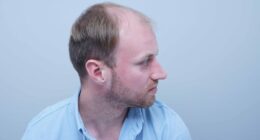 Before I had a hair transplant people thought I was in my 40s...now they think I'm TWENTY years younger
