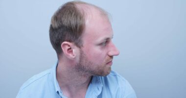 Before I had a hair transplant people thought I was in my 40s...now they think I'm TWENTY years younger