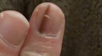 Doctors insisted a subtle change to my nail was nothing to worry about... in fact it was the ONLY sign of the deadliest kind of skin cancer. These are the easy-to-miss symptoms everyone must look out for
