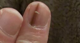 Doctors insisted a subtle change to my nail was nothing to worry about... in fact it was the ONLY sign of the deadliest kind of skin cancer. These are the easy-to-miss symptoms everyone must look out for