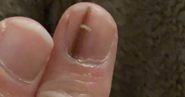 Doctors insisted a subtle change to my nail was nothing to worry about... in fact it was the ONLY sign of the deadliest kind of skin cancer. These are the easy-to-miss symptoms everyone must look out for