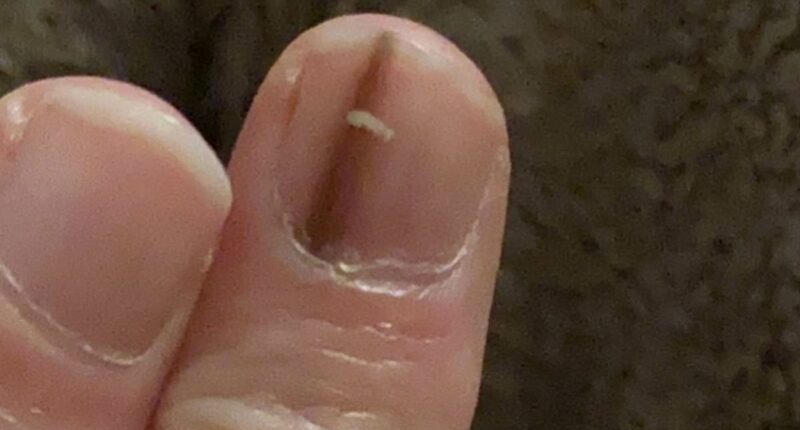 Doctors insisted a subtle change to my nail was nothing to worry about... in fact it was the ONLY sign of the deadliest kind of skin cancer. These are the easy-to-miss symptoms everyone must look out for