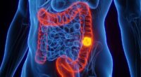 Doctors share 11 tips to lower your risk of developing bowel cancer - as cases surge in younger people