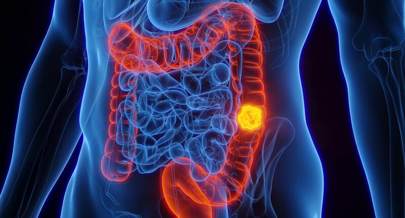 Doctors share 11 tips to lower your risk of developing bowel cancer - as cases surge in younger people