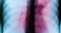 Drug-resistant 'white plague' is spreading undetected as one in five cases missed