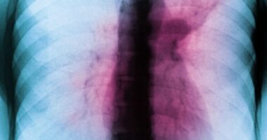 Drug-resistant 'white plague' is spreading undetected as one in five cases missed