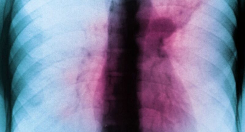 Drug-resistant 'white plague' is spreading undetected as one in five cases missed