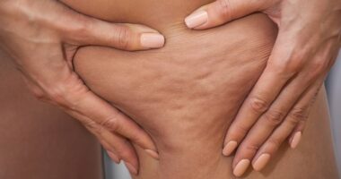 Experts reveal the difference between lipoedema and cellulite