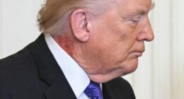 Fierce red rash spotted on Trump's neck