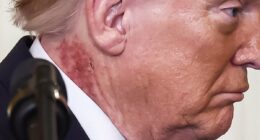 How to rid yourself of crusty skin patches triggered by sunlight. It strikes often on the scalp or chest and affects a quarter of those in middle-age. Now doctors reveal the drugs that work - and when you need to worry