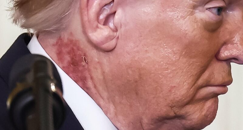 How to rid yourself of crusty skin patches triggered by sunlight. It strikes often on the scalp or chest and affects a quarter of those in middle-age. Now doctors reveal the drugs that work - and when you need to worry