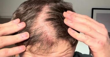 I started going bald at 25. Now I have REVERSED my hair loss with this DIY at-home routine and combination that takes just a few minutes a day. But be warned, it comes with major sacrifices