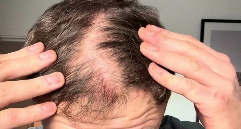 I started going bald at 25. Now I have REVERSED my hair loss with this DIY at-home routine and combination that takes just a few minutes a day. But be warned, it comes with major sacrifices