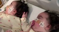 Jesy Nelson shares new snaps of her twin daughters with their splints