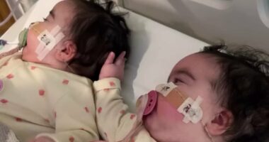 Jesy Nelson shares new snaps of her twin daughters with their splints