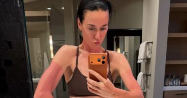 Katy Perry shares painful looking picture of her sunburn after going on ski trip as she poses for rare picture with her daughter Daisy Dove