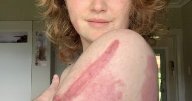 Kelsey Waghorn was a 25-year-old tour guide and one of 47 people on New Zealand's White Island when it erupted on December 9, 2019. She has written a book about that day and its aftermath. She is pictured IN April 2020 showing some of her injuries