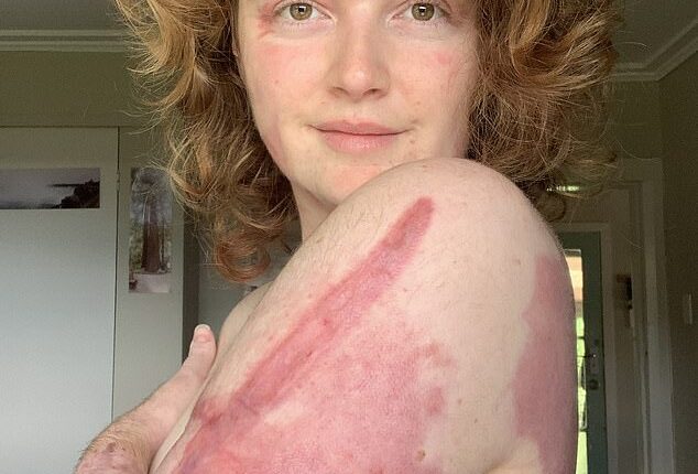 Kelsey Waghorn was a 25-year-old tour guide and one of 47 people on New Zealand's White Island when it erupted on December 9, 2019. She has written a book about that day and its aftermath. She is pictured IN April 2020 showing some of her injuries