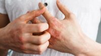 New PILL for psoriasis approved... giving hope to millions suffering from debilitating skin condition