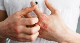 New PILL for psoriasis approved... giving hope to millions suffering from debilitating skin condition