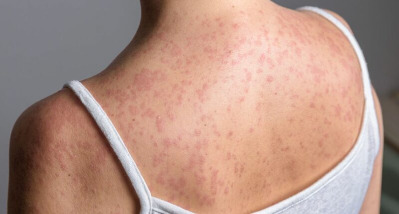 Panic as Victorian disease spreads across 50 UK areas – see map