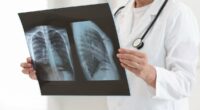 Severe cases of covid and the flu linked to increased lung cancer risk years after recovery, warns new study