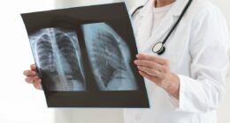 Severe cases of covid and the flu linked to increased lung cancer risk years after recovery, warns new study