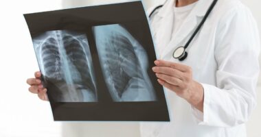 Severe cases of covid and the flu linked to increased lung cancer risk years after recovery, warns new study